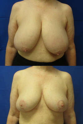 breast reduction before & after