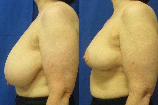 breast reduction before & after