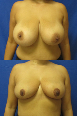 breast reduction before & after