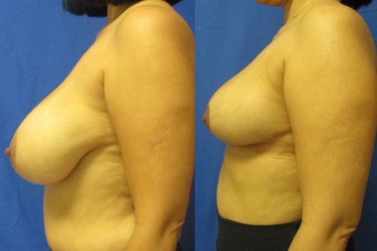 breast reduction before & after