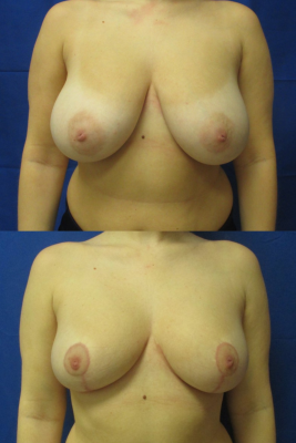 breast reduction before & after