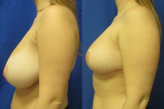 breast reduction before & after