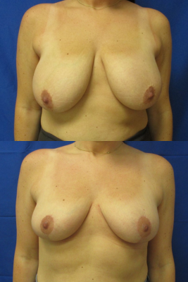breast reduction before & after