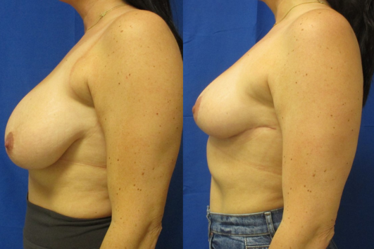 breast reduction before & after