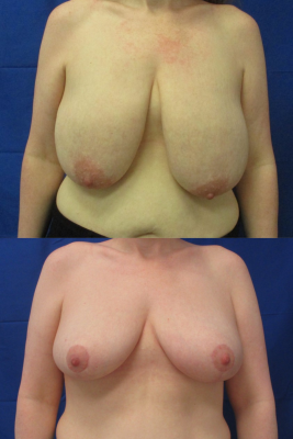 breast reduction before & after