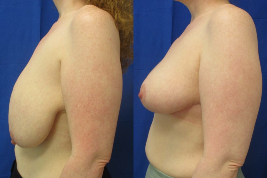 breast reduction before & after