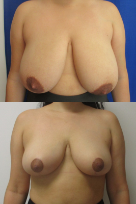 breast reduction before & after