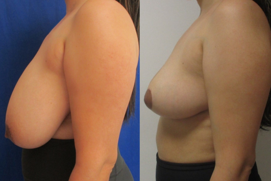 breast reduction before & after