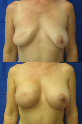Breast Augmentation with Breast Lift before & after