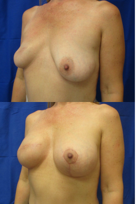 Breast Augmentation with Breast Lift before & after