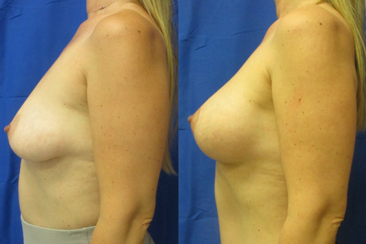 Breast Augmentation with Breast Lift before & after