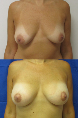 Breast Augmentation with Breast Lift before & after