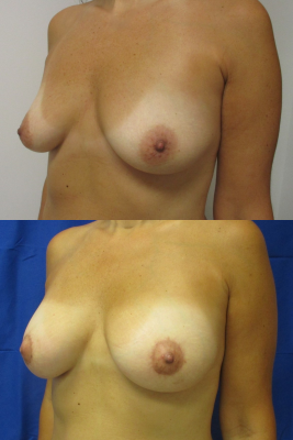 Breast Augmentation with Breast Lift before & after