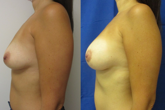 Breast Augmentation with Breast Lift before & after