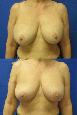 Implant removal & breast lift before and after