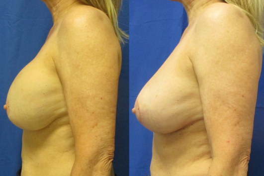 Implant removal & breast lift before and after