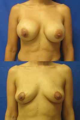 Implant removal & breast lift before and after