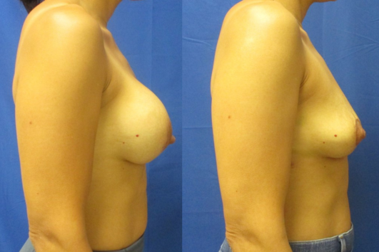 Implant removal & breast lift before and after