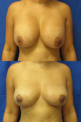 Implant removal & breast lift before and after