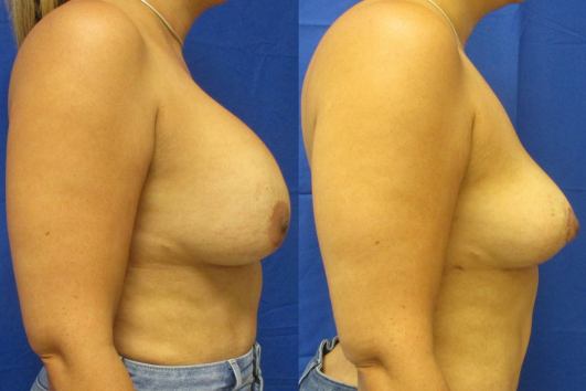 Implant removal & breast lift before and after