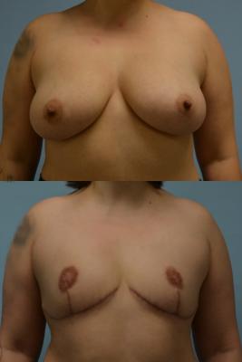 BREAST REDUCTION