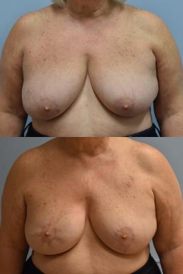 BREAST RECONSTRUCTION