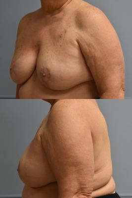 BREAST RECONSTRUCTION