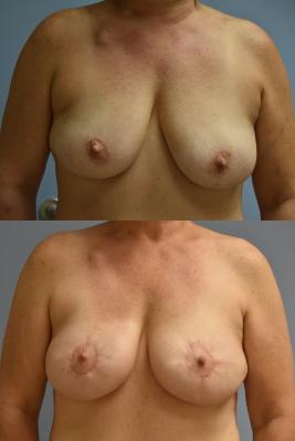 BREAST RECONSTRUCTION