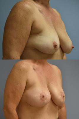 BREAST RECONSTRUCTION