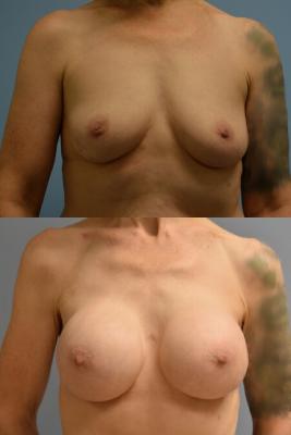 BREAST RECONSTRUCTION