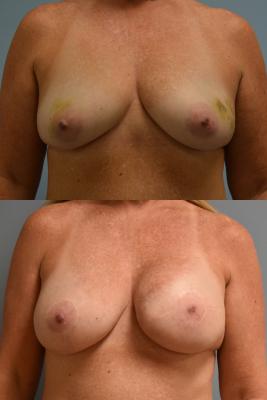 BREAST RECONSTRUCTION