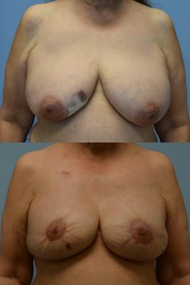 BREAST RECONSTRUCTION