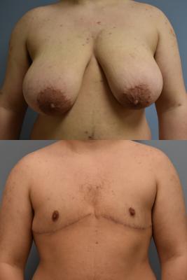 TOP SURGERY