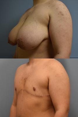 TOP SURGERY