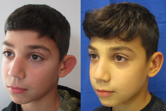 otoplasty of left ear before & after