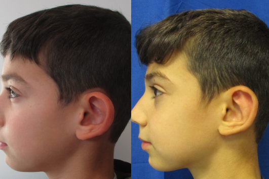 otoplasty of left ear before & after