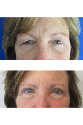 Bilateral Upper Eyelid Blepharoplasty before & after