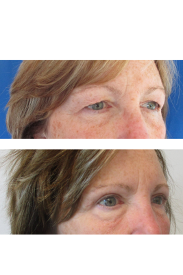 Bilateral Upper Eyelid Blepharoplasty before & after