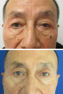 Bilateral Upper Eyelid Blepharoplasty before & after
