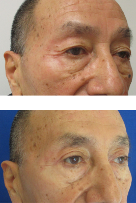 Bilateral Upper Eyelid Blepharoplasty before & after