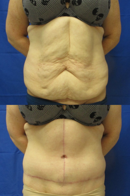Fleu de Lis Abdominoplasty before & after