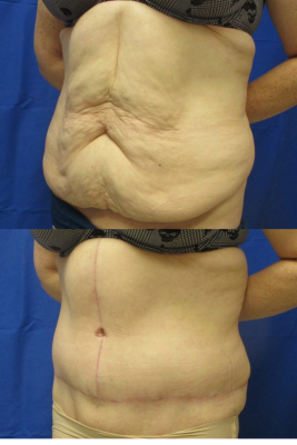 Fleu de Lis Abdominoplasty before & after