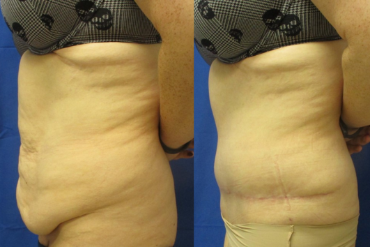 Fleu de Lis Abdominoplasty before & after