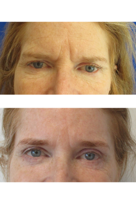 Brow Lift, Bilateral Upper & Lower Blepharoplasty before & after