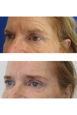Brow Lift, Bilateral Upper & Lower Blepharoplasty before & after