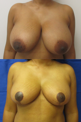 breast reduction before & after
