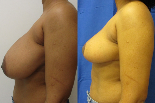 breast reduction before & after