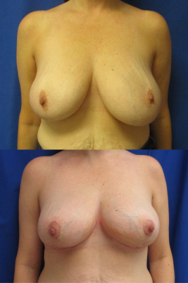 breast reduction before & after