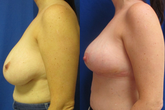 breast reduction before & after
