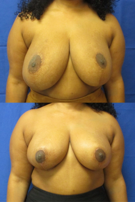 breast reduction before & after